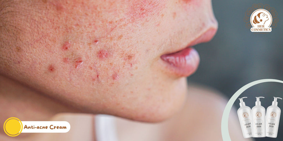 Comment débarrasser les acnés du visage?